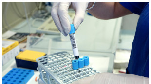 Test del sangue predice il declino fisico e cognitivo in anziani